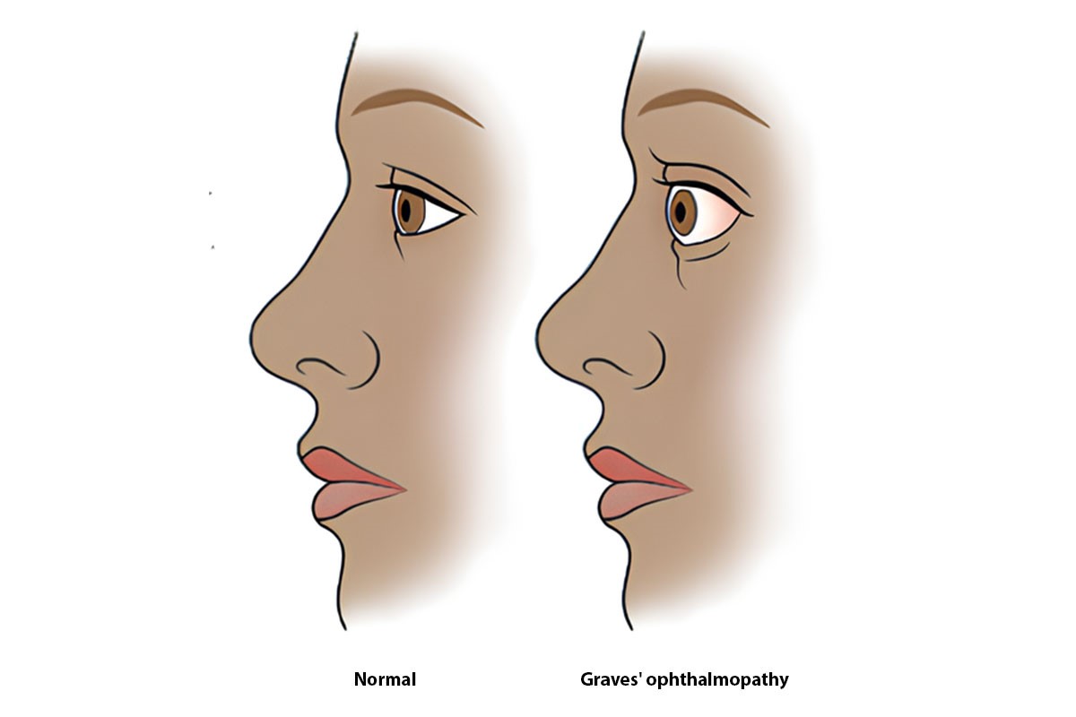 Tiroid Oftalmopati Nedir? Nasıl Tedavi Edilir?